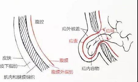 腹外疝图解图片